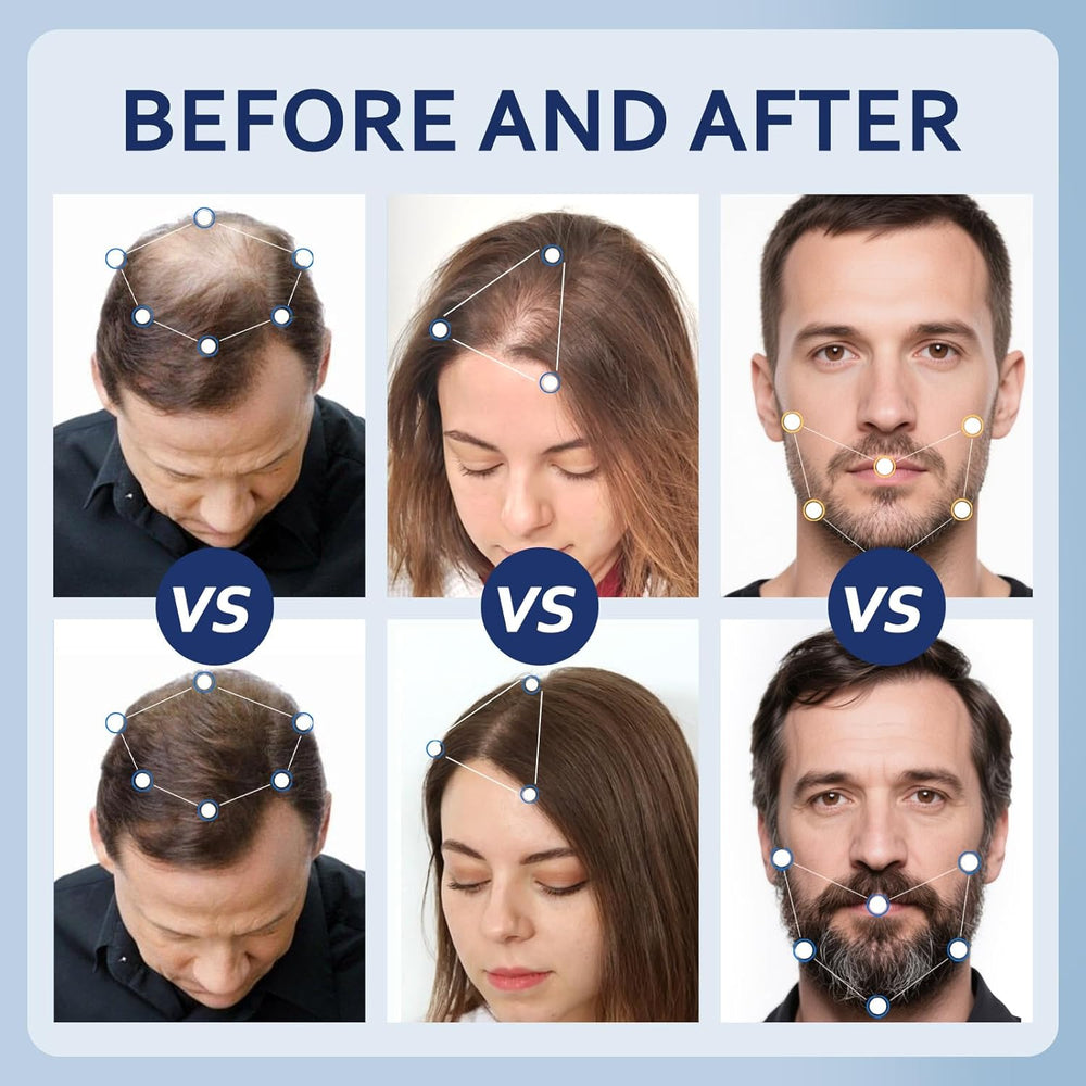 5% Minoxidil Hair Growth Serum for Men & Women with Biotin: Minoxidil for Men and Women, 5 Percent, Hair Regrowth Treatment, Extra Strength (12 FL OZ, Dropper 6)